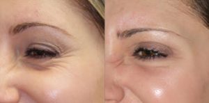 Botox injections St. Louis Park MN Aesthetica Skin Health