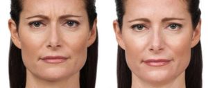 Botox Injections St. Louis Park Woodbury MN Aesthetica