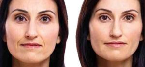 Facial Filler St. Louis Park MN Aesthetica