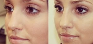 St. Louis Park MN NonSurgical Rhinoplasty_before_after_1