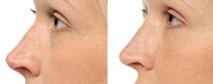 NonSurgical Rhinoplasty St. Louis Park MN_before_after_2