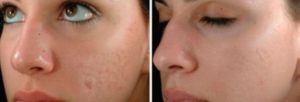 Skinpen Treatments St. Louis Park Edina Woodbury MN